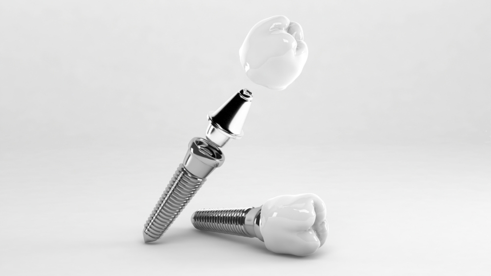 Coroana-dentara-pentru-implant-Velvet-Dental